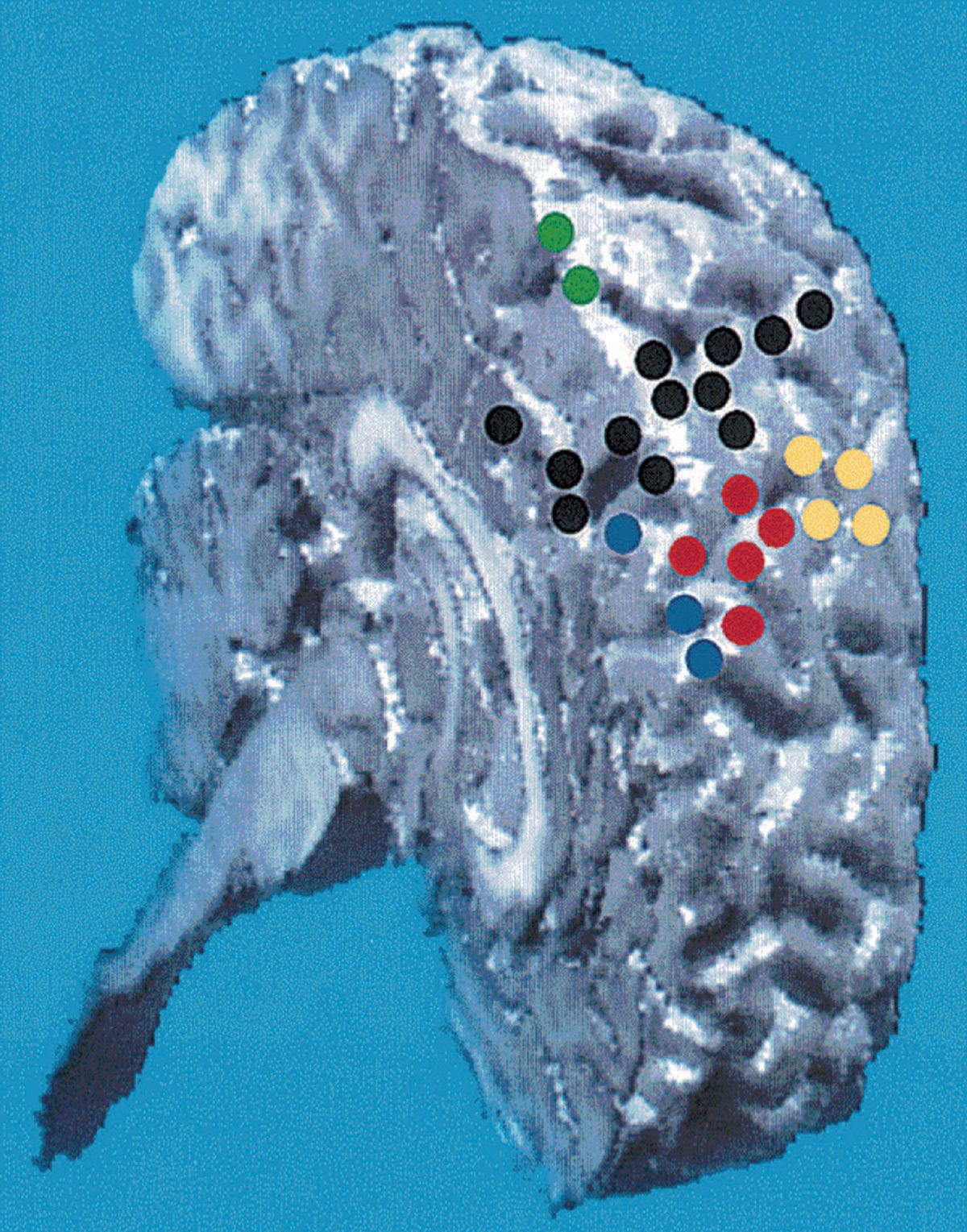 A 3-D reconstruction of an MRI scan of a 16-year-old girl suffering from severe epilepsy. The scan shows sites in the left hemisphere of her brain where electrical stimulation evoked behavioral responses such as laughter, disruption or arrest of speech, naming and manual activity, motor movements involving the lower and upper extremities, tingling sensations in the right lower extremity.