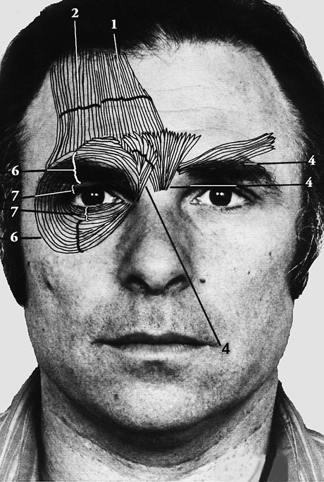 Charting the muscles underlying facial actions (AUs), here in
the upper face. AUs 1 & 2—inner and outer parts of the frontalis
pull the medial and lateral parts of the forehead skin up;
AU 4—combination of corrugator, procerus, and depressor
supercilii pull the brow down and together; AUs 6 & 7—outer
and inner parts of orbicularis oculi raise the cheek around
the eye and tighten the eyelid. Image from a revised CD-ROM
version of Facial Action Coding System by Paul Ekman, Wallace
Friesen, and Joseph Hager.